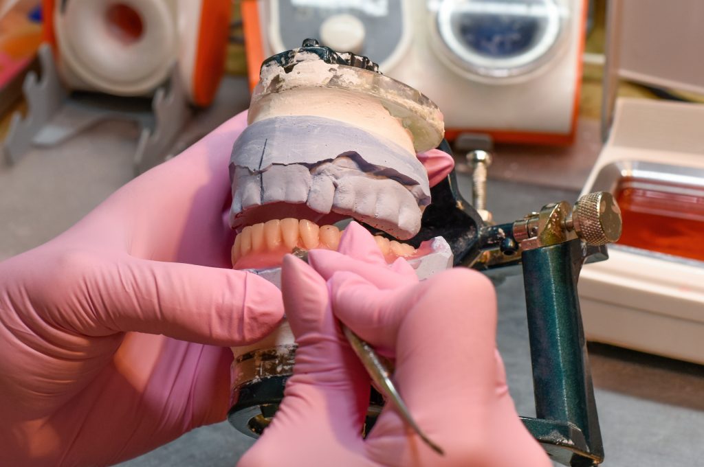 Implantes cigomáticos vs. subperiósticos