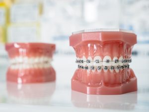 Modelos dentales con brackets metálicos antes de una cirugía ortognática